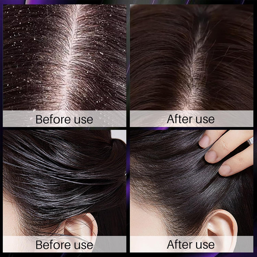 Champu De Cebolla Y Romero Con Biotina, Onion, Biotin and Rosemary Shampoo and Conditioner Set, Onion Shampoo for Hair Growth, Stronger, Thicker and Longer Hair (3 PCS)