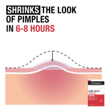 Load image into Gallery viewer, Sensitive Skin Pimple Patches, Hydrocolloid Patches, Acne Treatment, 2 Sizes, 30 Count
