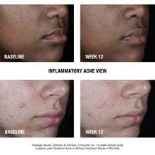 Load image into Gallery viewer, Stubborn Acne AM Treatment with Benzoyl Peroxide, 2.0 Oz
